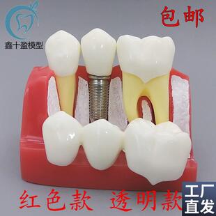 牙科口腔教学4倍种植解说v模型牙冠可拆卸替换种植钉展示模型包邮