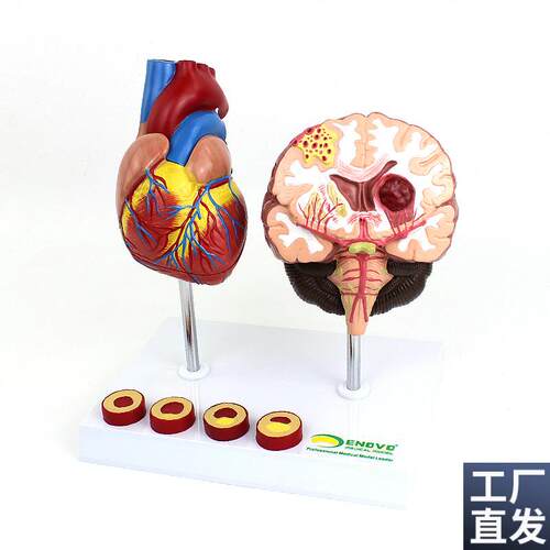 ENOVO颐诺心脑血管疾病展示模型高血L压心脏心血管疾病模型脑