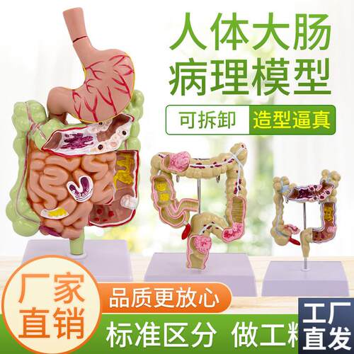 大肠病理模型大肠模型大肠病y变模型肠道疾病人体结肠病变模型