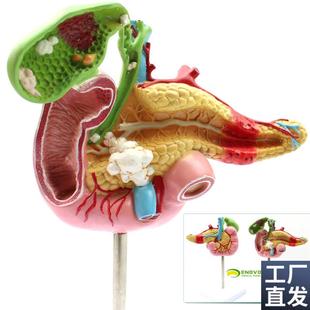ENOVbO颐诺医学胰腺十二指肠胆囊病理模型外科消化科系统模具肝胆