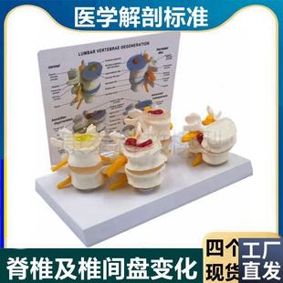 腰椎模型椎间盘受压突出演u示老年人脊椎劳损病理比较椎骨正骨推