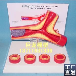 人体支脉粥样硬化m和血栓管形成模型人体模型人体解剖模型