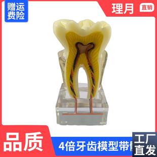 牙科种植a模型学习教学分解模医患沟通牙模4倍比例展示牙模带髓腔