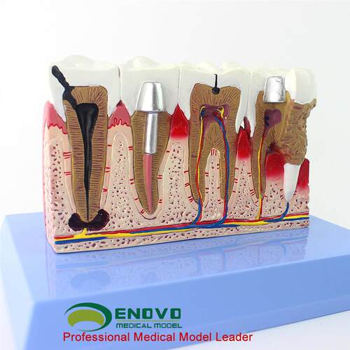 ENOVO颐诺L牙齿模型口腔牙齿科疾病种植修复模型口腔病理模型