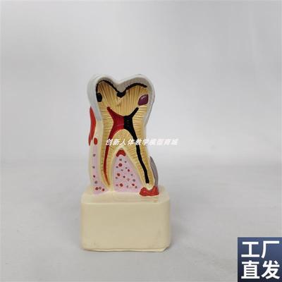 四倍人体牙齿解剖模型牙龈炎w蛀齿蛀牙牙齿出血牙结石切面演示牙
