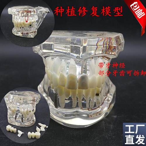 牙科材料连桥h修复体模型病理牙模型可拆卸活动牙种植体包邮