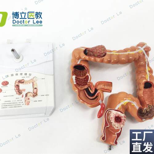 教学结肠病理模型大肠病变w标本肠道医患沟通交流人体器官解剖