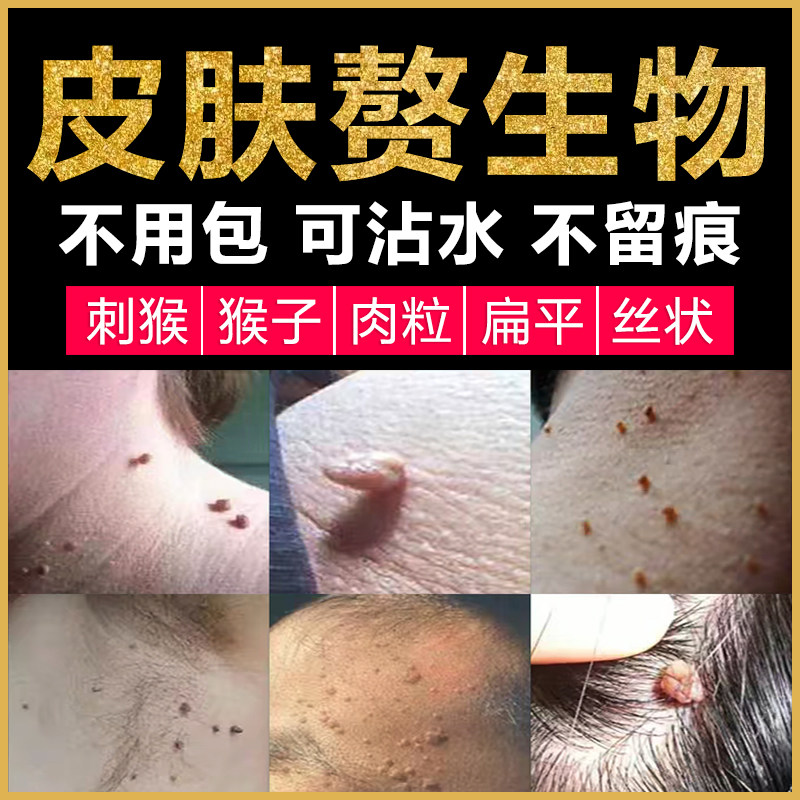 脖子上长小肉粒疙瘩肉球的药专去除刺猴子皮赘神器扁平丝状根用膏