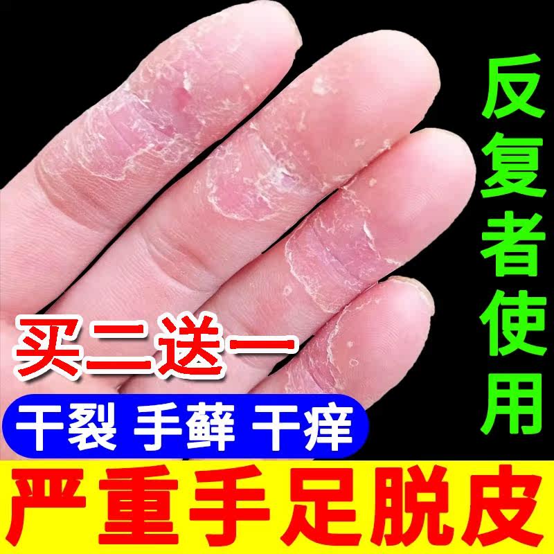 手癣,手癣长什么样,手癣湿疹_大山谷图库