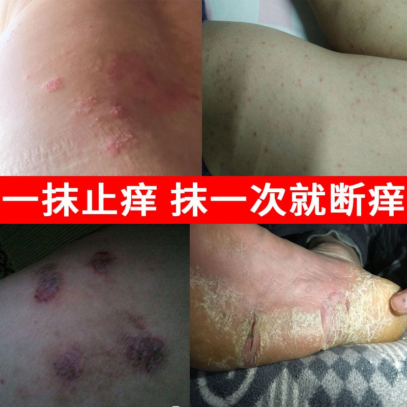 顽固性湿疹特效皮炎湿疹头皮癣