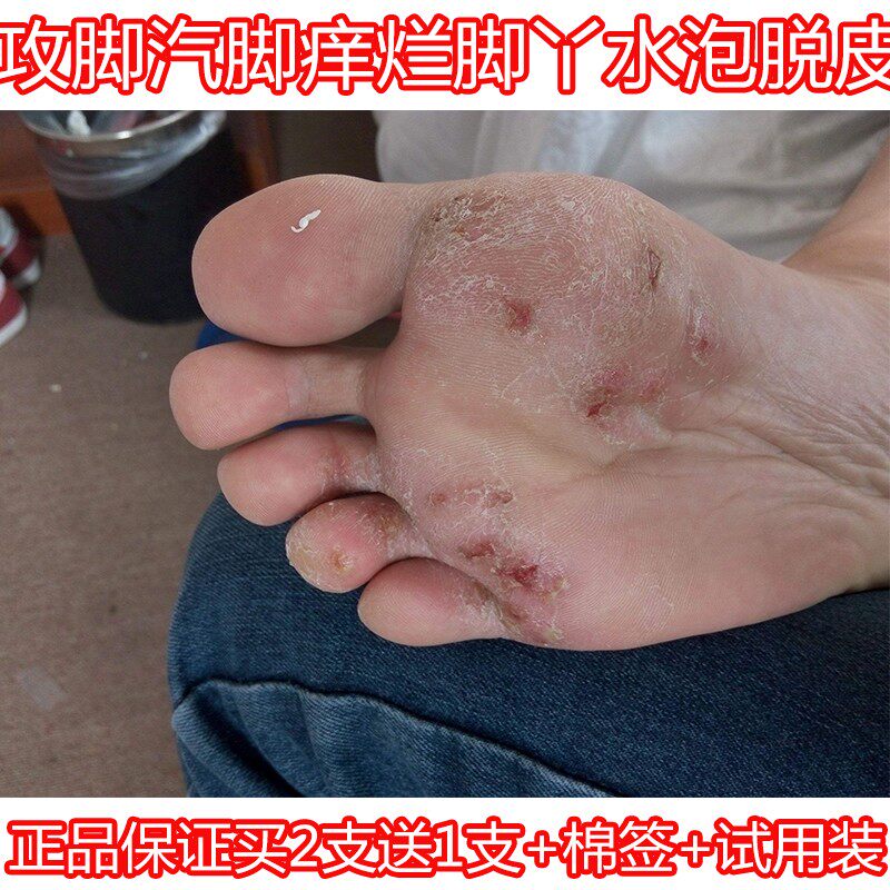 皮康王脚气抑菌膏草本乳膏正品止痒杀菌百痒宁乳膏烂脚丫脚痒膏