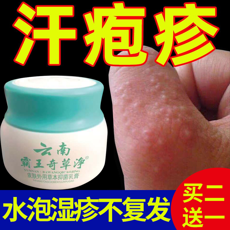 汗疱疹汗状疱疹手癣膏真菌感染手指上痒起小水泡专治