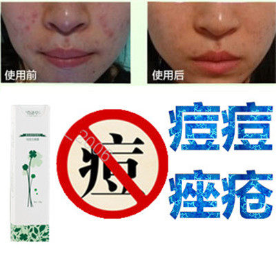 正品植物面疮酒刺胸前豆豆油性痘痕立消去除青少年痘痘全清修复液