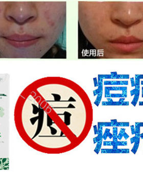 正品植物面疮酒刺胸前豆豆油性痘痕立消去除青少年痘痘全清修复液