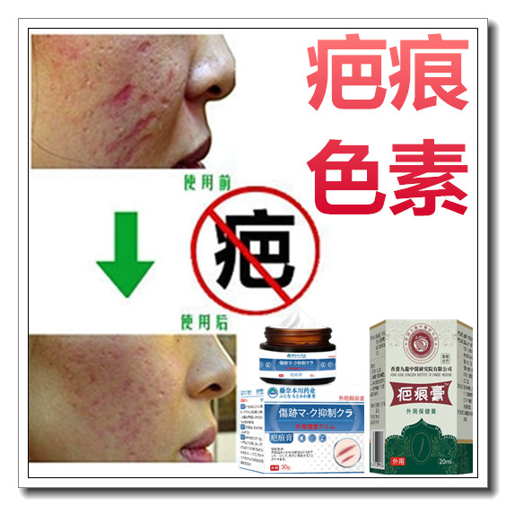 草本去除黑色素沉着修复膏淡化黑印祛男女士色素印痕疤痕印伤疤贴
