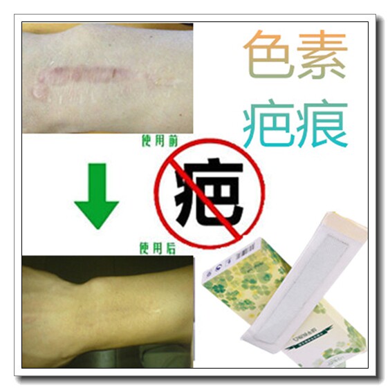 祛儿童伤口刀疤痕去脖子黑色素沉淀淡化黑印巴痕药修复剖腹产后贴