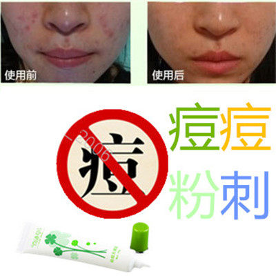 正品植物暗疮印疤痕酒刺痤疮青少年痘痘立消除去胸前豆豆油性痘痕