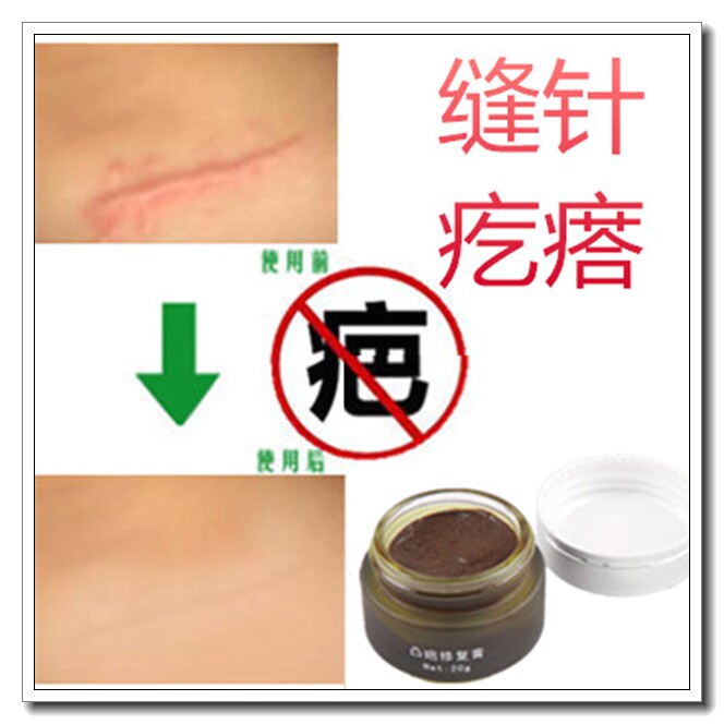 去除儿童脸部烫伤修复膏贴陈旧舒疤痕宁祛巴膏正品疤不得留进口液
