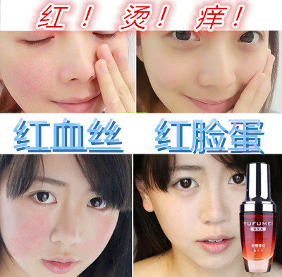 舒缓祛鼻翼脸部红血丝修复角质层增厚正品去除敏感肌肤精华液男女