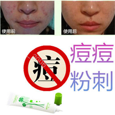正品植物暗疮印克星酒刺痤疮青春痘痘全清除去后背部豆豆痘痕乳霜
