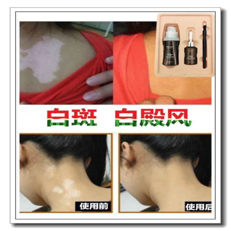 正品去持久白斑净遮盖液防水白殿风药膏防汗白斑霜修复消除白点风
