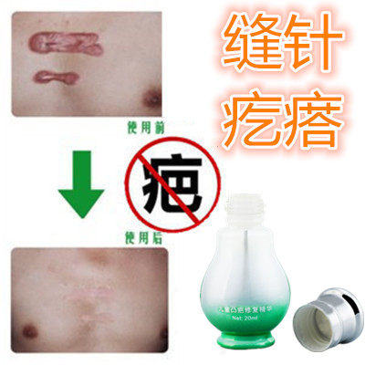 去除缝针后烟烫软化剖宫产凸疤疙瘩破腹产刮伤巴痕抓痕摔伤修复液