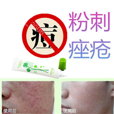 正品暗疮痘痘立消除去前胸后背酒刺黑头痘痕霜祛豆豆脂肪粒痤疮平