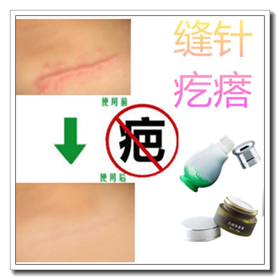 除去全身纹身贴手腕遮伤疤痕印淡化私处黑色素医用修复脸部的药膏