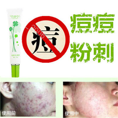 奇迹草本产品药用去除男女后背部封闭合性痤疮痘痕消除祛胸前暗疮