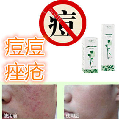 奇迹草本正品祛面部痘痘粉刺立消除去后背部青春痘痤疮酒糟鼻精华