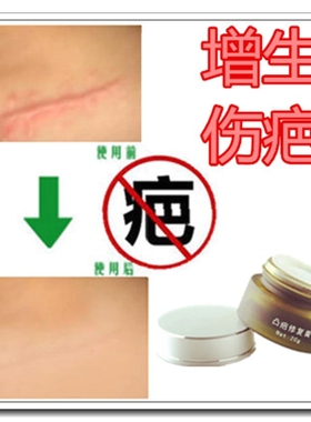 修复剖腹产后伤口药膏贴淡化黑色素祛儿童红印薰衣草精油去刀疤痕