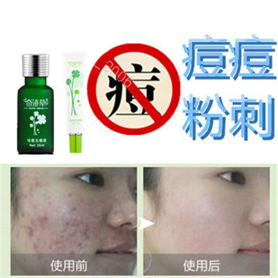 正品除去男女面部前胸后背额头痘痘粉刺青春痘修复痤疮酒糟鼻产品