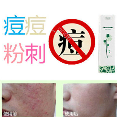 奇迹草本祛前胸封闭合性酒刺青春痘痘去除后背白头痘痕脂肪粒痤疮