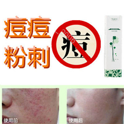 正品暗疮痘疤痕祛除封闭合性背上痘痘立消无痕霜痘痕印脂肪粒痤疮
