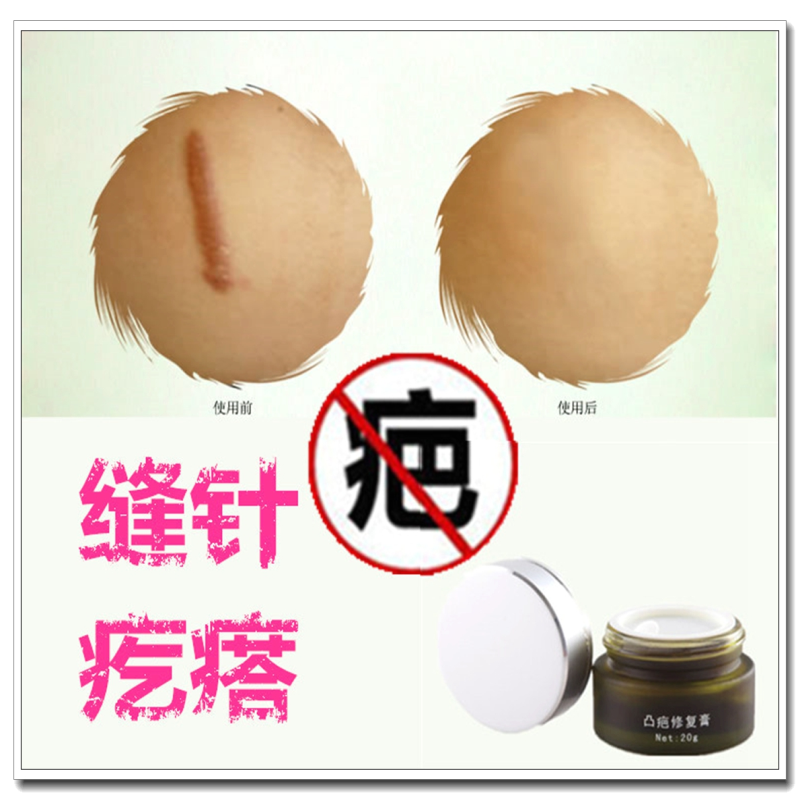 修复增生性凸起祛耳洞肉疙瘩药膏去除女士疤痕体质烟疤男士烫伤贴