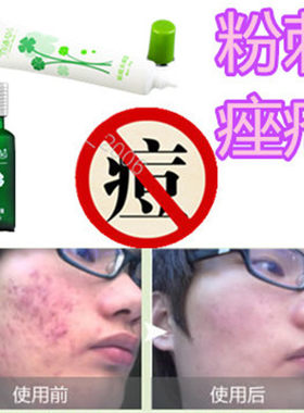 封闭合性白头痤疮立消除祛前胸粉刺平液去后背豆豆酒渣鼻油脂粒霜