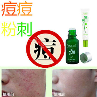 正品药用祛后背部豆豆膏胸前封闭合性痘痘立消除去霜粉刺印痤疮平