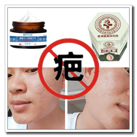 正品祛烟烫疙瘩淡化儿童增生性凹凸手术烧伤药疤痕印消去色素药膏