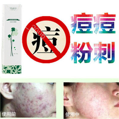 奇迹草本药用正品封闭合性青春豆痘立消疤痕脂肪粒痤疮去除痘痕霜