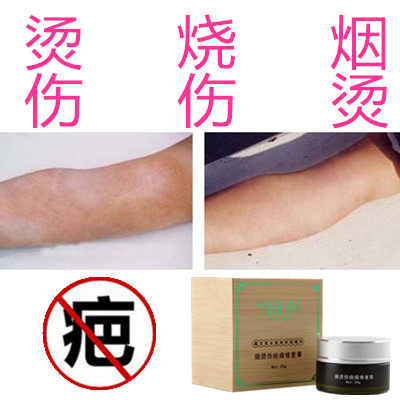 除去烧伤凹凸烟疤痕印色素灵修复霜软化烟烫增生性冻疮疙瘩药正品