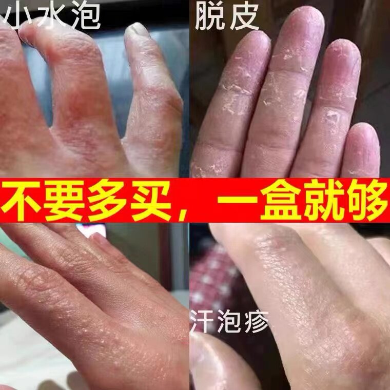 手脱皮真菌感染汗泡疱疹鹅掌风特效孢疹药膏治手癣脚癣干裂小水泡