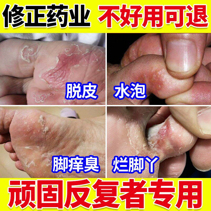 修正脚上长起小水泡止痒气脱皮杀菌脚趾缝糜烂脚丫根臭专用喷雾去