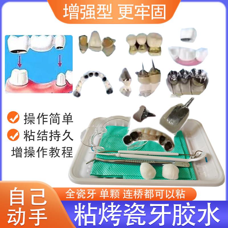 烤瓷牙粘接剂假牙粘合剂全瓷牙冠自己粘金属牙套连桥钢牙专用胶水