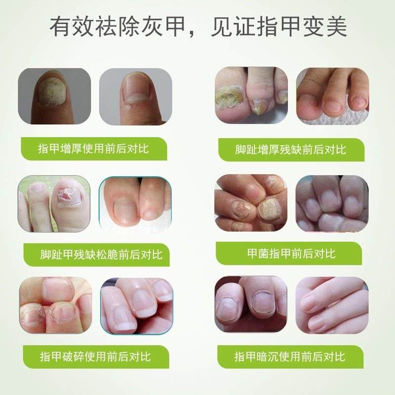 灰甲易钾抑菌套装护甲促进指甲生长甲床抑菌买5盒2两盒,保健用品,皮肤消毒护理（消）,淘宝优惠券,粉丝福利购,淘宝优惠卷