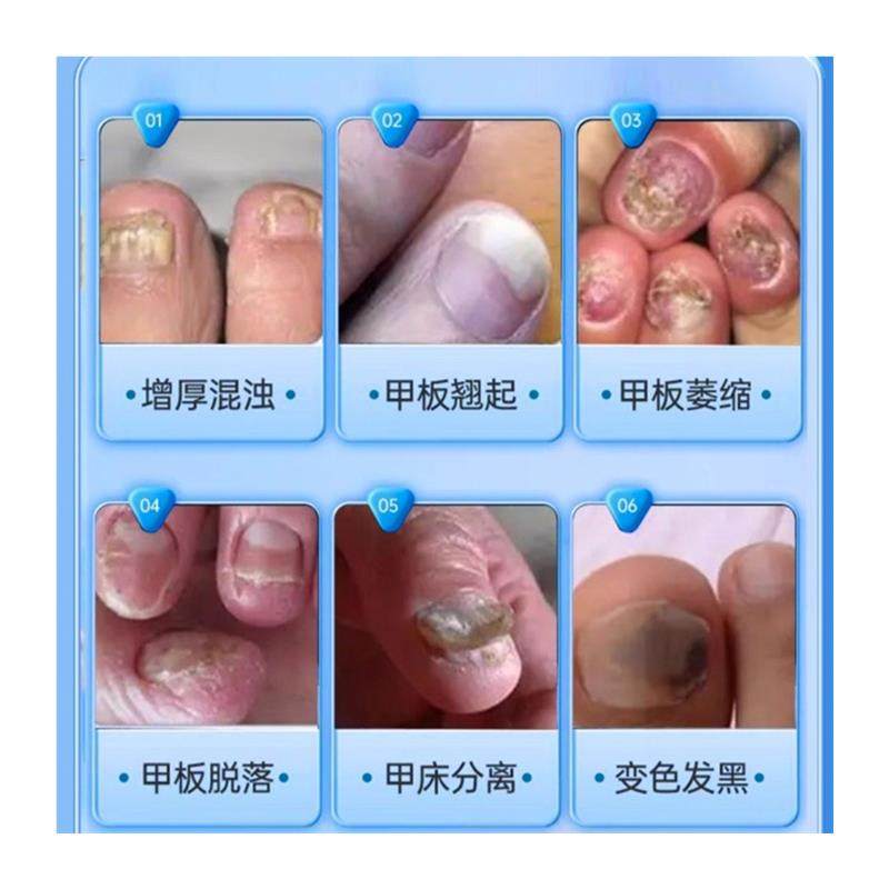 脱甲膏灰甲65克去甲包6天后用热水泡了剪修送胶布剪刀锉刀买3套,保健用品,皮肤消毒护理（消）,淘宝优惠券,粉丝福利购,淘宝优惠卷