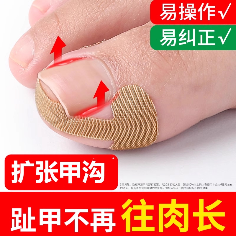 甲沟矫正器嵌甲神器防脚指甲隔离填充垫片便携设计专用工具实用