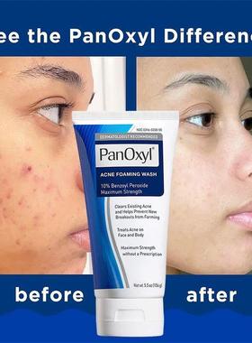 156g PanOxyl 10% Benzoyl Peroxide Pore Deep Cleansing Foam