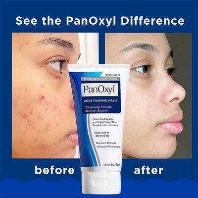 156g PanOxyl 10% Benzoyl Peroxide Pore Deep Cleansing Foam