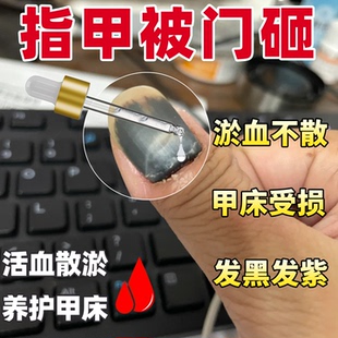 指甲淤血手脚趾甲被砸夹变黑发紫受损护甲养甲床修复再生生长液SY