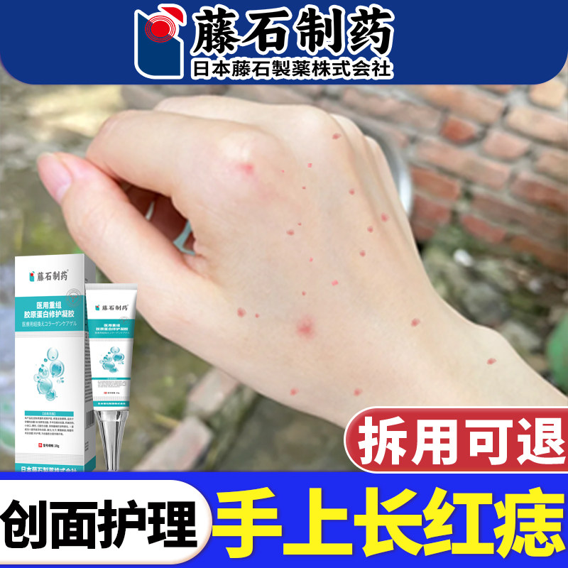 藤石制药血管瘤血管痣除蜘蛛痣樱桃状手上小红点痣凝胶创面专用E8,医疗器械,保健理疗,淘宝优惠券,粉丝福利购,淘宝优惠卷